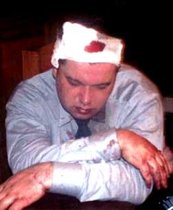 Ілля Ковальов після побиття в ресторані "Жеглов"