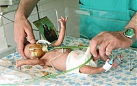 В Ужгороді врятували 800-грамове немовля (ФОТО)
