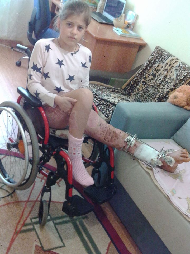 Дівчинка, травмована "комунальною" гілкою в Ужгороді, після піврічного лікування вже вдома (ФОТО)