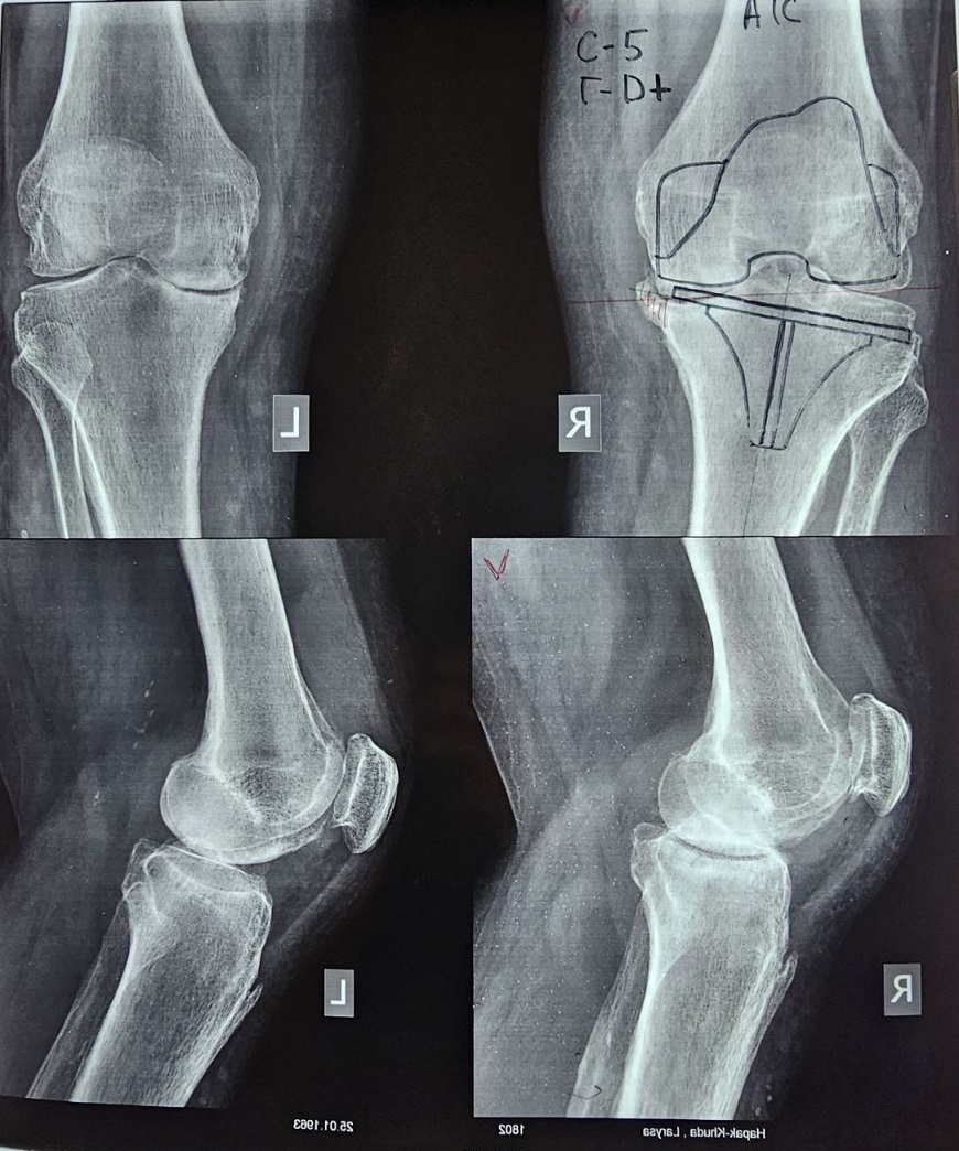 У Закарпатській обласній лікарні проводять безкоштовне ендопротезування колінних суглобів