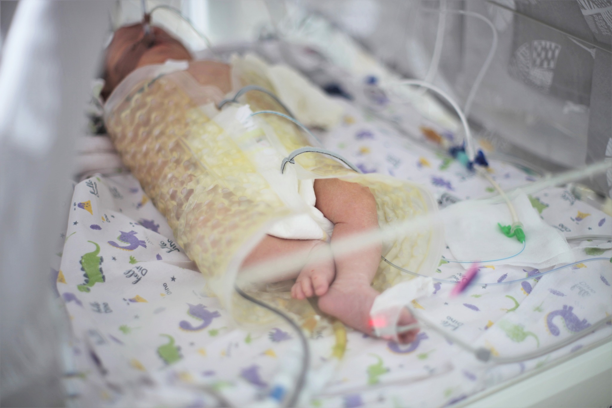 У лікарні Мукачева проводять штучне охолодження немовлят заради порятунку їхнього життя (ФОТО)