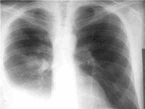 В Ужгороді з квітня не роблять щеплення проти туберкульозу (ВІДЕО)