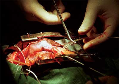 На Закарпатье впервые провели операцию на открытом сердце - аортокоронарное шунтирование