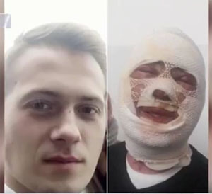 20-річному уродженцю Тячівщини, що з ревнощів хлюпнув кислотою в обличчя ужгородцю, загрожує від 5 до 8 років в'язниці
