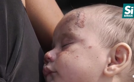 Життю піврічного малюка, що обпікся гарячим бульйоном на Берегівщині, нічого не загрожує (ВІДЕО)