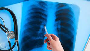 На Закарпатті в серпні виявлено 74 хворих на туберкульоз