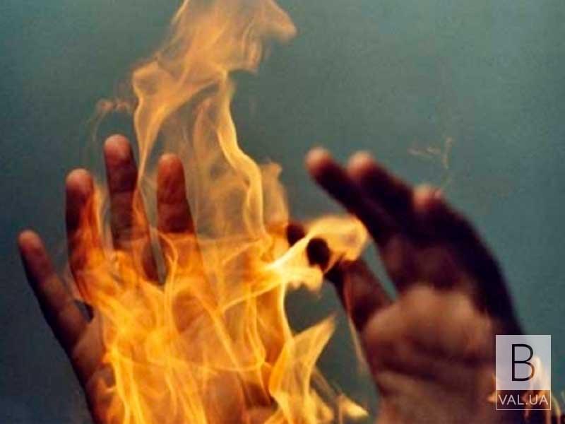В Іршаві чоловік на пожежі отримав опіки обличчя та кистей рук
