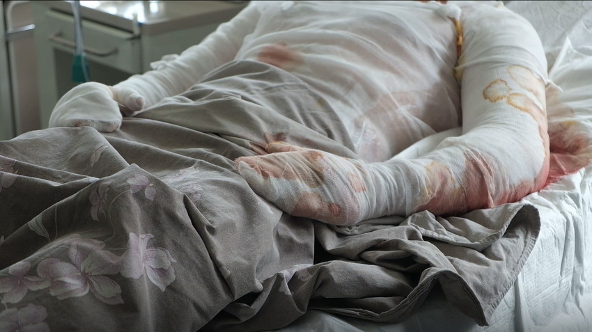 У Мукачеві до лікарні потрапив мешканець Страбичова з 36% опіків тіла