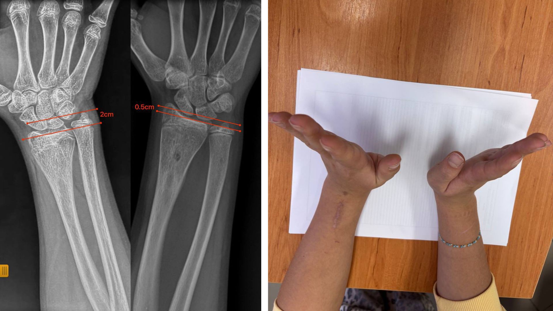 Закарпатські лікарі відновили ріст кістки 12-річній пацієнтці без складної операції (ФОТО)