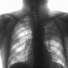 З початку року у Мукачеві зафіксовано 11 хворих на туберкульоз, у районі – 21 (ВІДЕО)