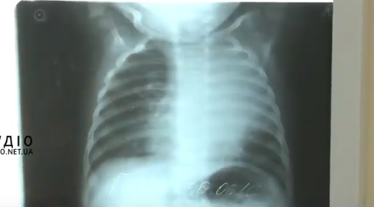 Від туберкульозу на Закарпатті за рік померли 150 людей (ВІДЕО)